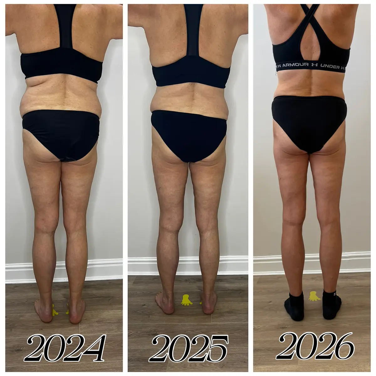 Before and after regular LPG Endermologie over 4 years, second angle, at Endermika, Prestwich