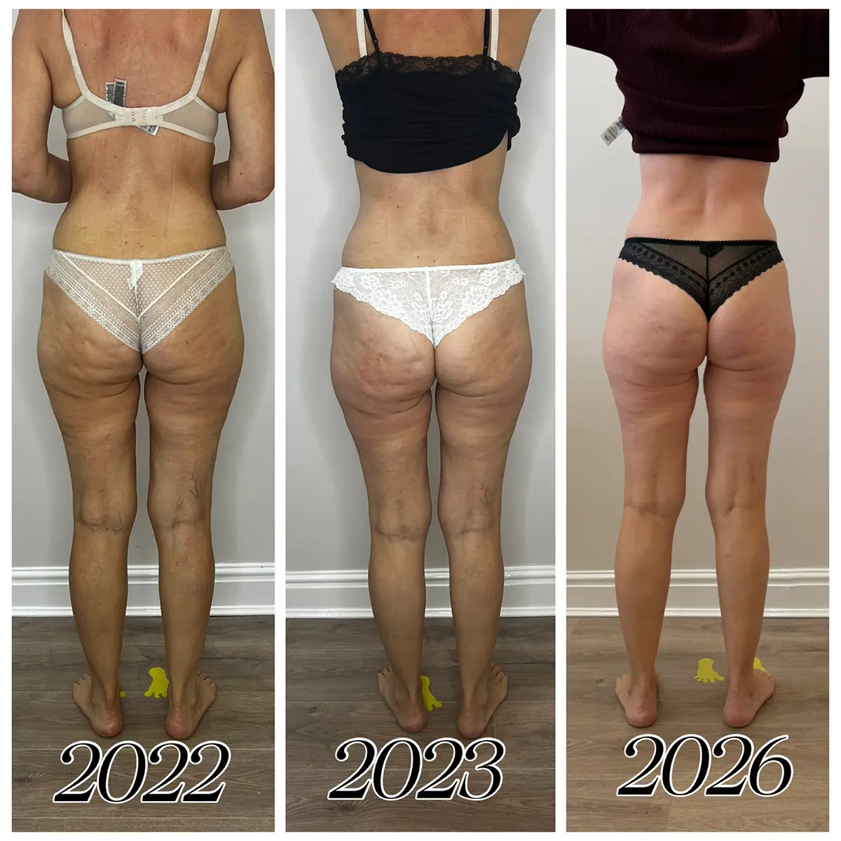 Before and after regular LPG Endermologie over 4 years at Endermika, Prestwich
