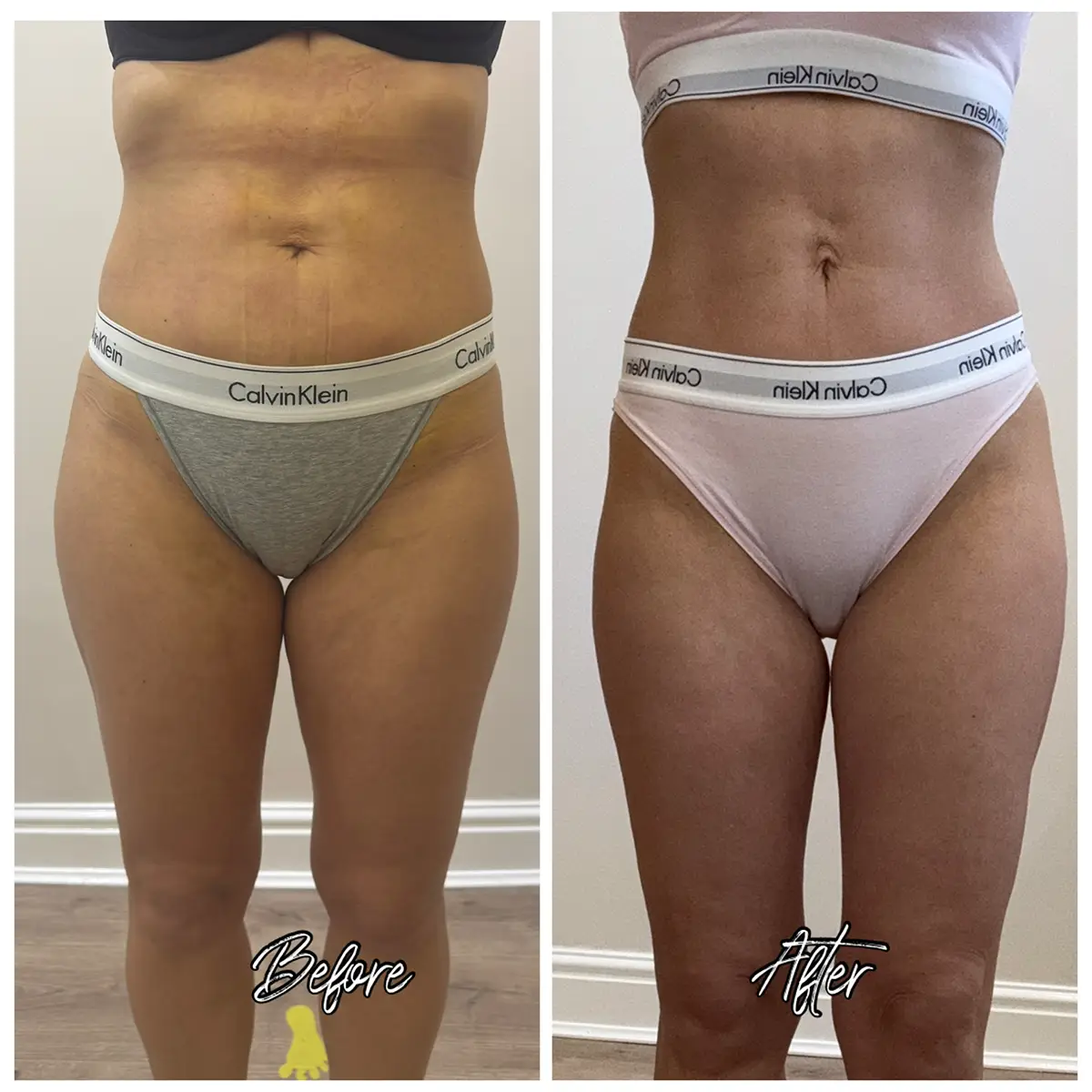 Before and after LPG Endermologie, 12 sessions of 50 minutes at Endermika, Prestwich