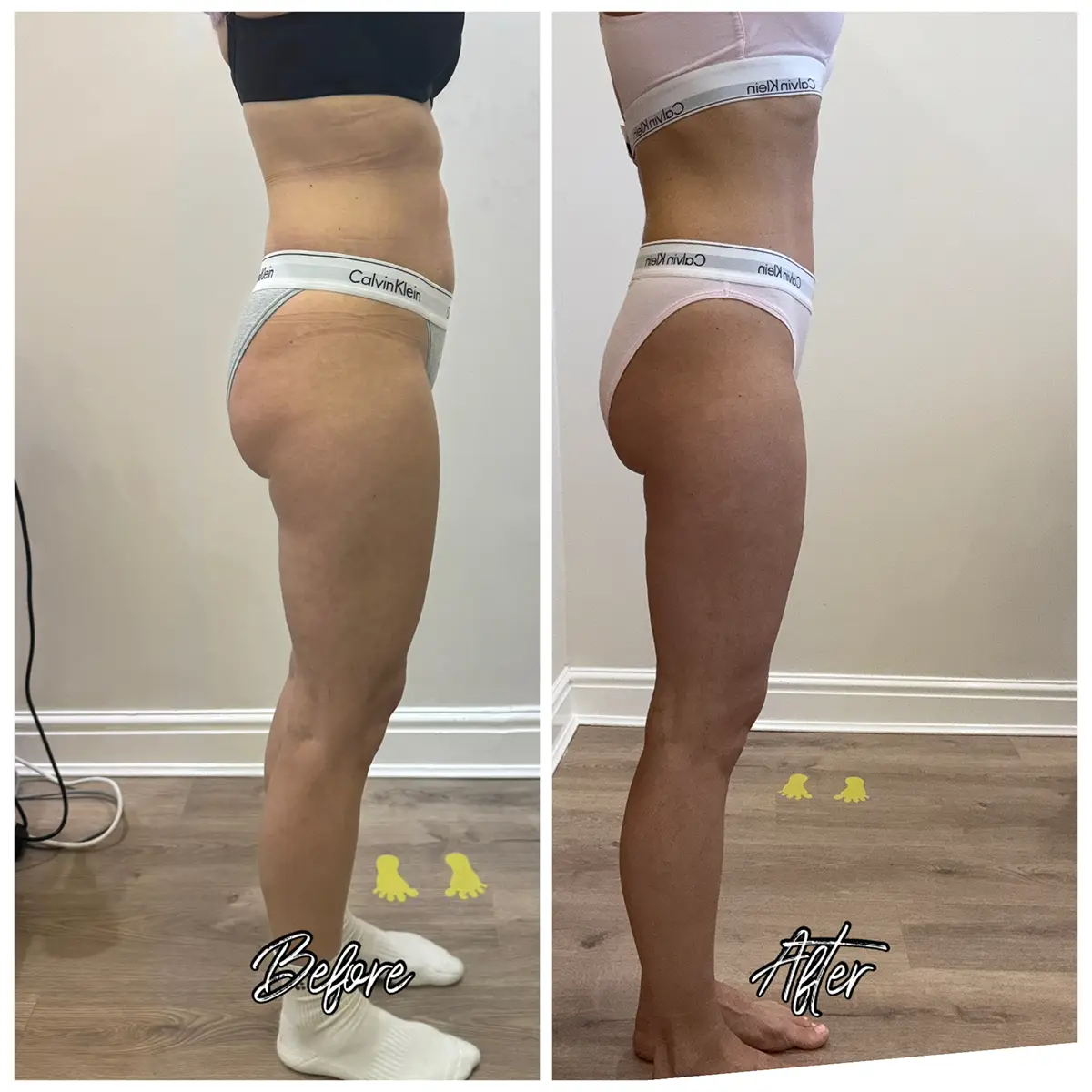 Before and after LPG Endermologie, second angle, 12 sessions of 50 minutes at Endermika, Prestwich
