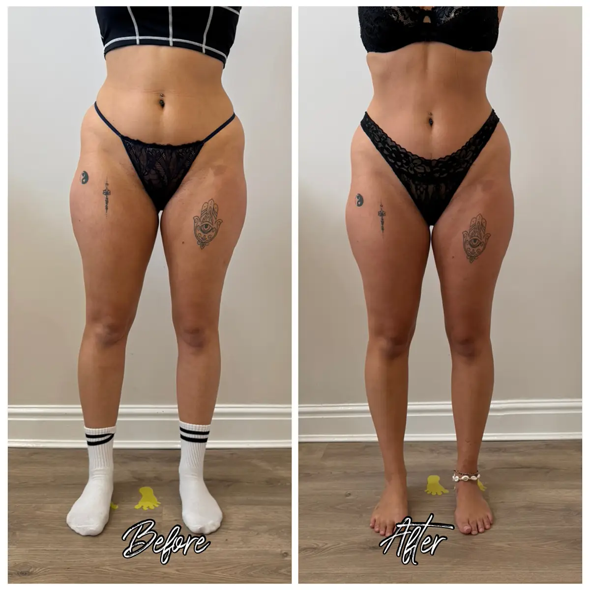 Before and after LPG Endermologie course, 12 sessions of 50 minutes at Endermika, Prestwich
