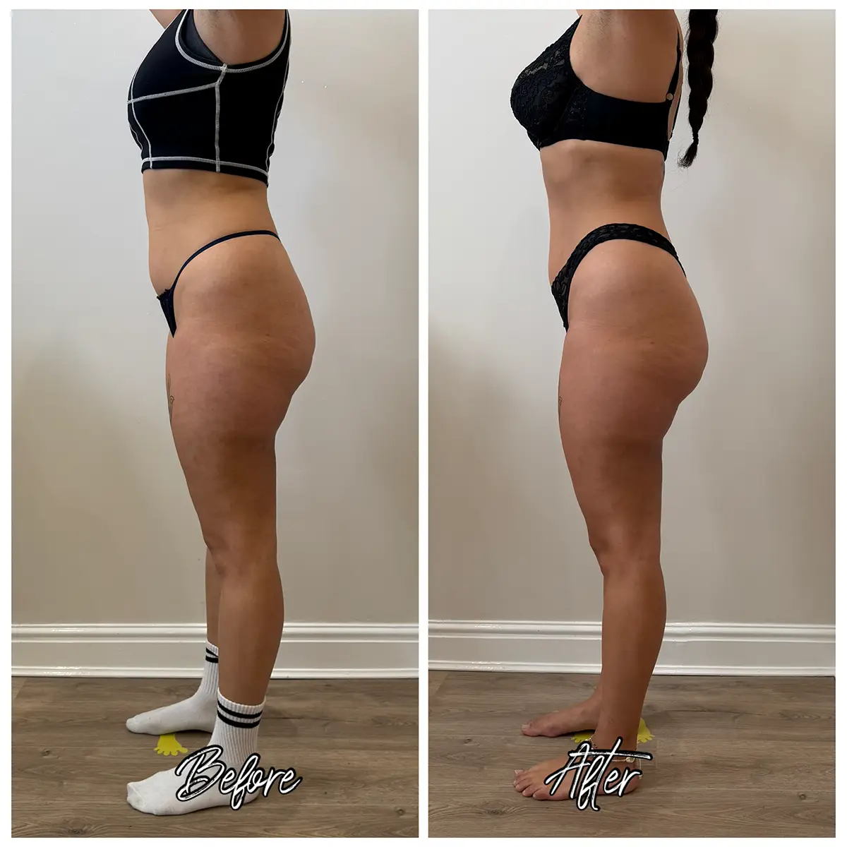 Before and after LPG Endermologie course, second angle, 12 sessions of 50 minutes at Endermika, Prestwich