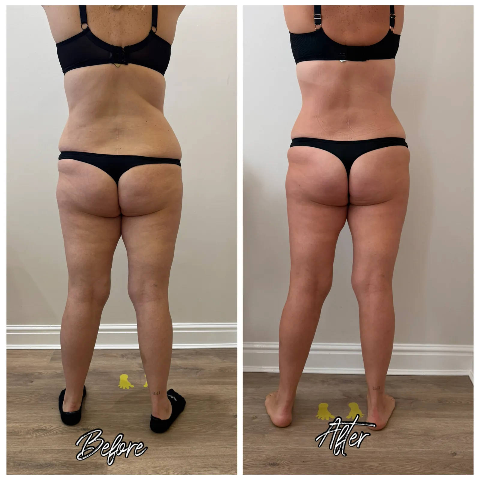 Before and after LPG Endermologie, back view, 12 sessions of 50 minutes at Endermika, Prestwich