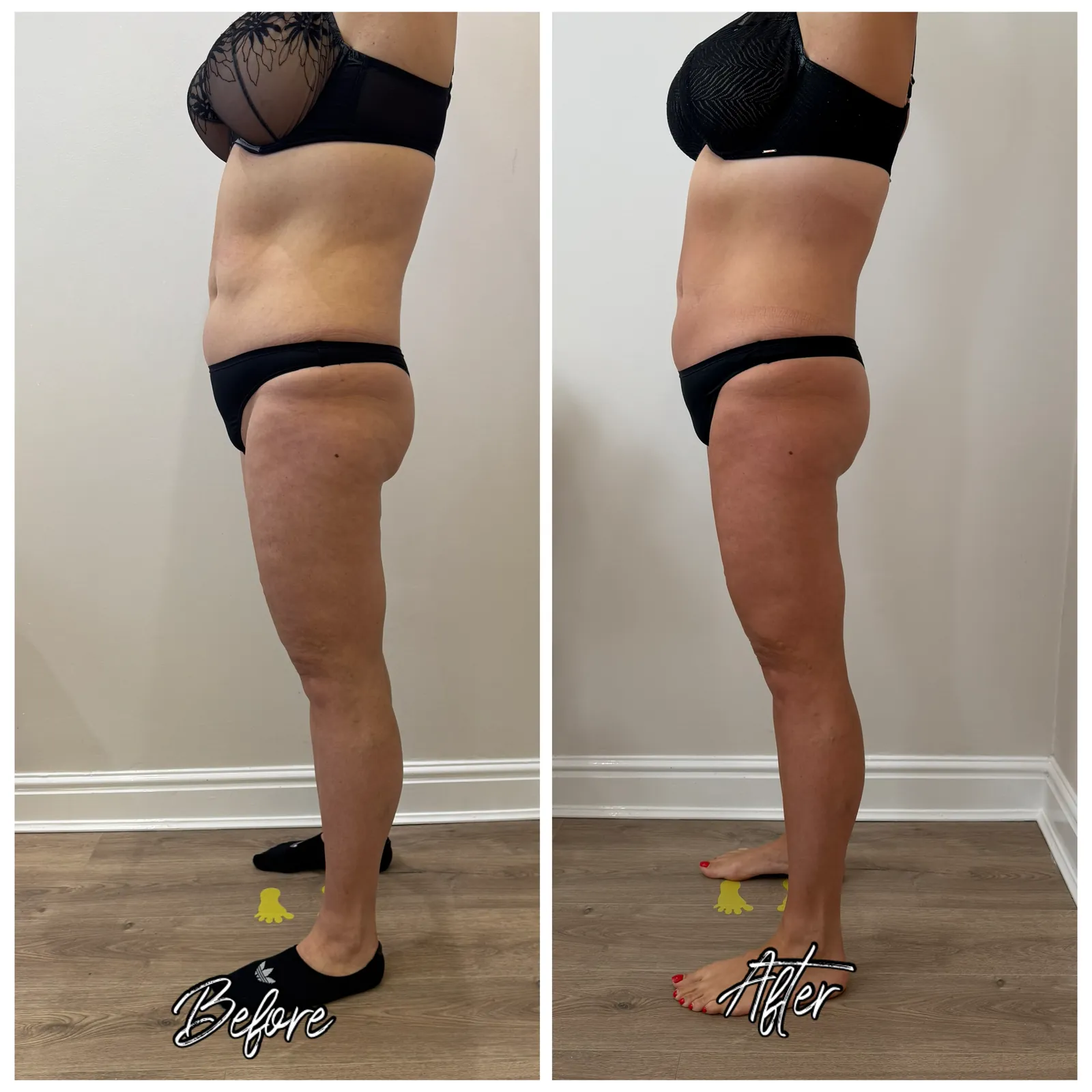 Before and after LPG Endermologie, second angle, side view, 12 sessions of 50 minutes at Endermika, Prestwich